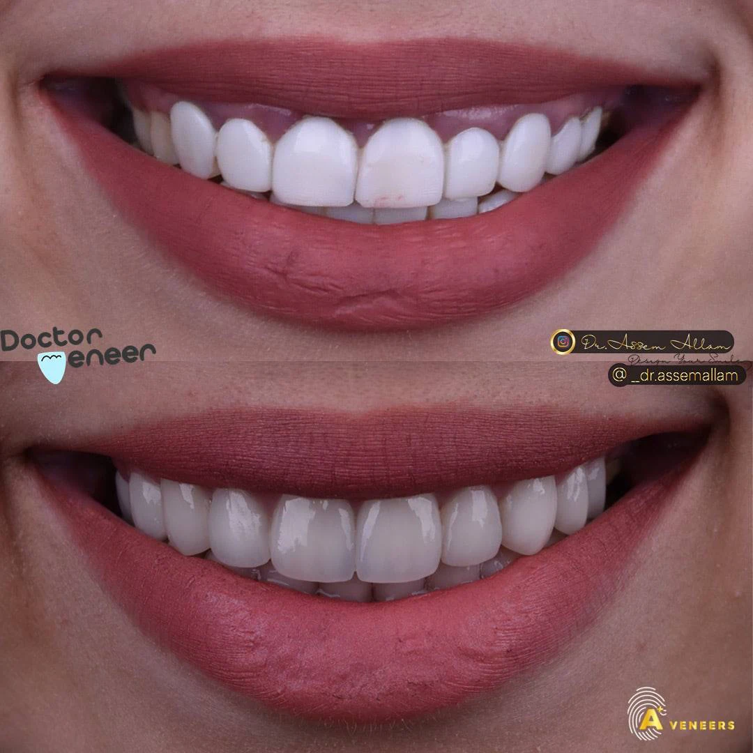 Shrouk Smile Before and After